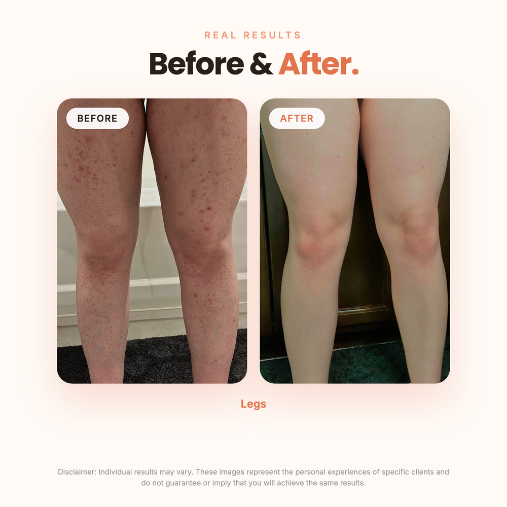 Before and after, BBL Serum