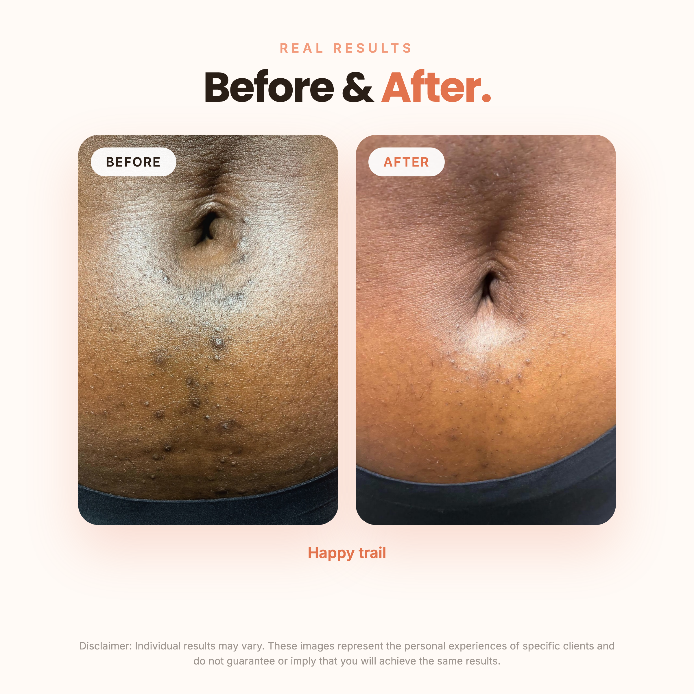 BBL Serum